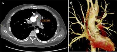 Case Report: Coil embolization of ascending aortic pseudoaneurysm in patient with Behcet's disease